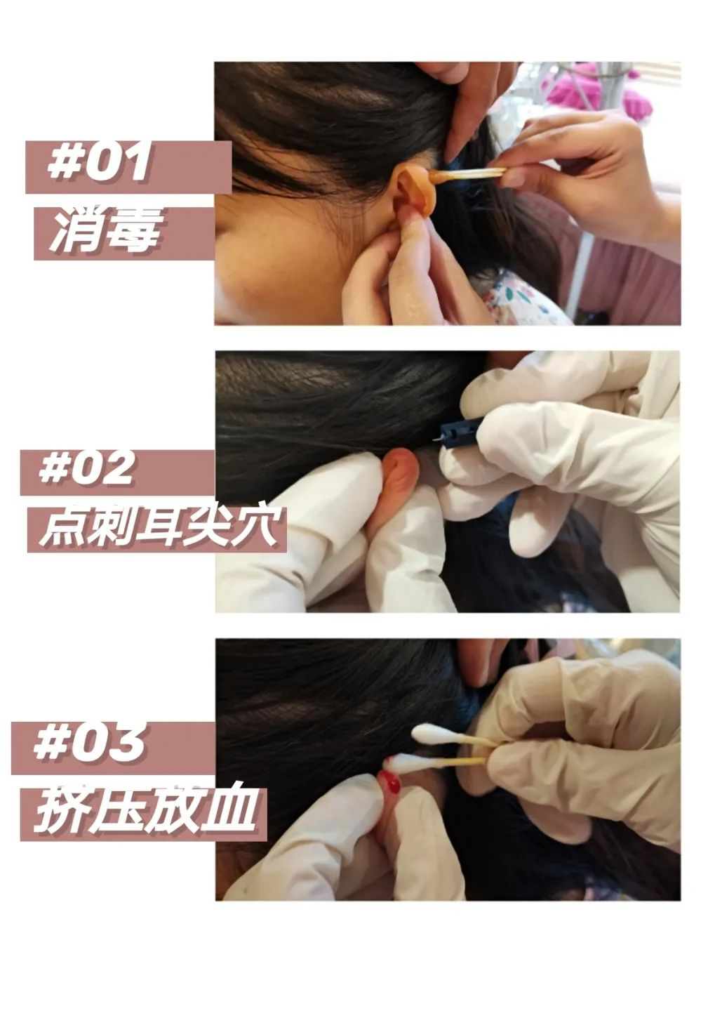 耳垂放血疗法位置图片图片